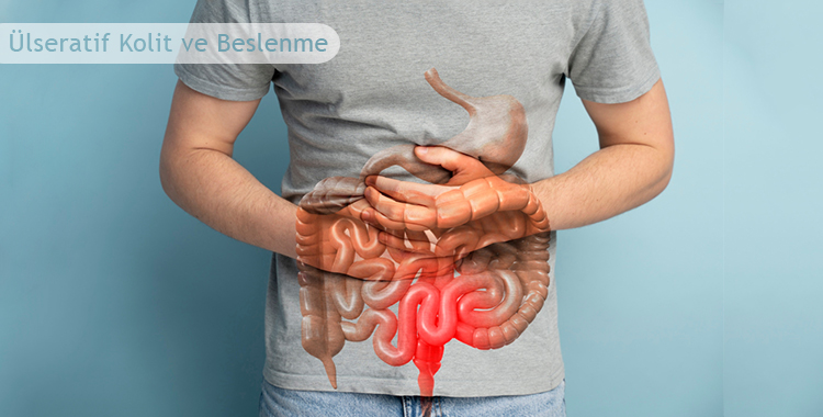 Ülseratif Kolit ve Beslenme