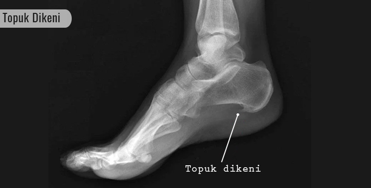 Topuk Dikeni Nedir? Belirtileri, Nedenleri ve Tedavi Yöntemleri