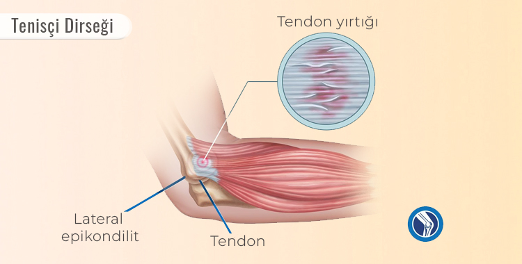 Tenisçi Dirseği Nedir? Belirtileri, Nedenleri ve Tedavi Yöntemleri